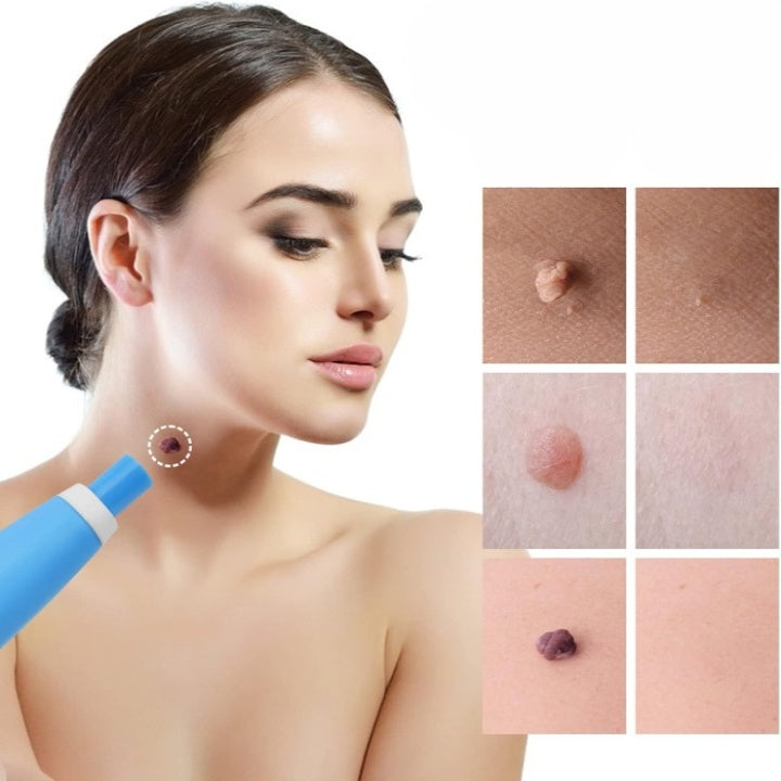 Skin Tag Removal Kit Painless Micro-Compression Scar-Free