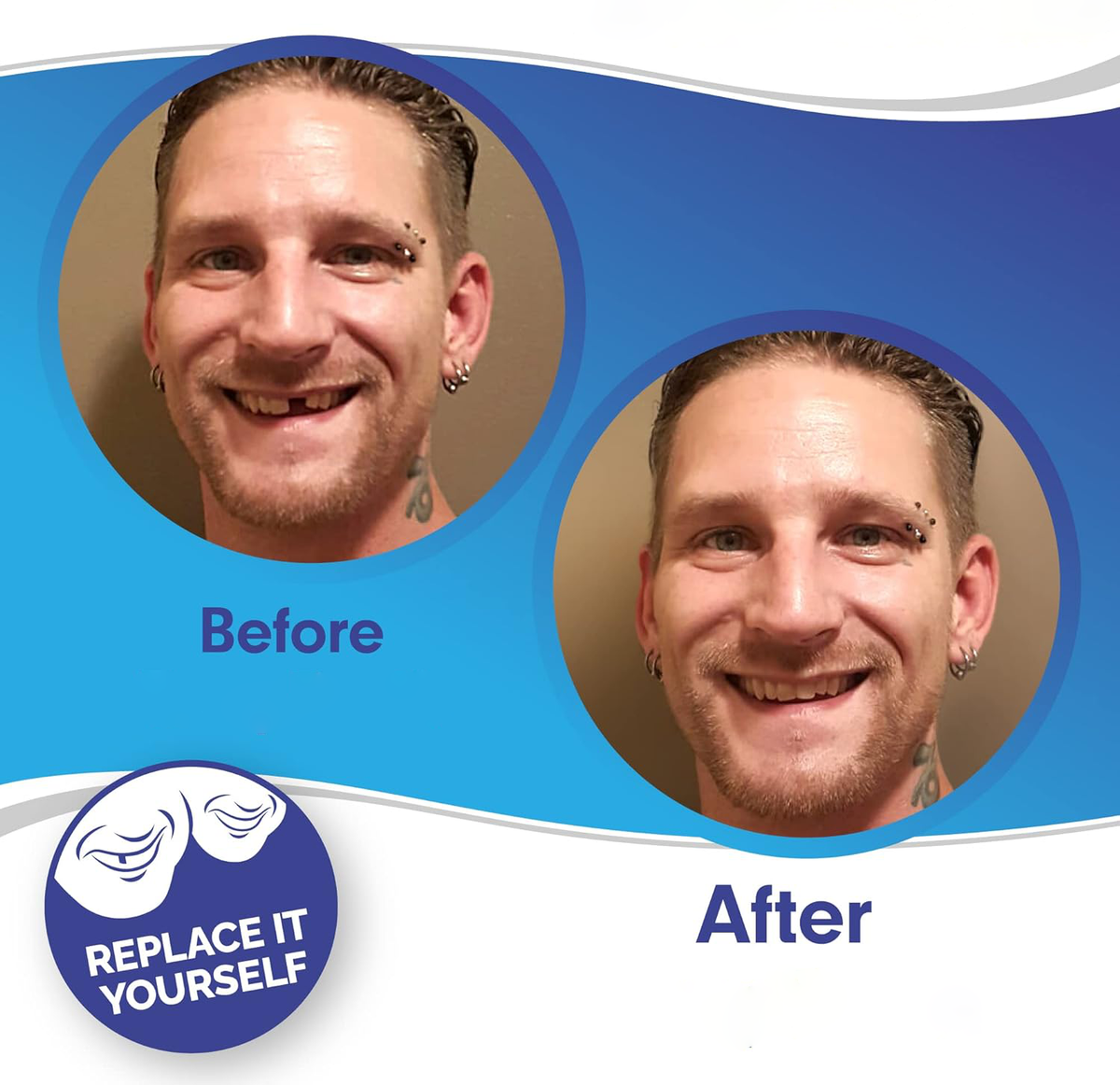 Radiant Smile Veneers – Complete Upper & Lower Set