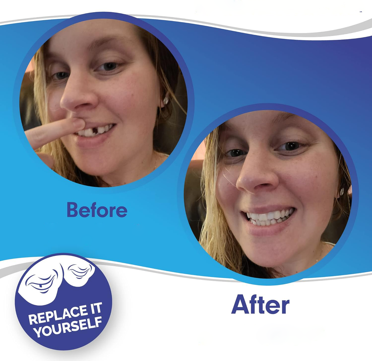 Radiant Smile Veneers – Complete Upper & Lower Set