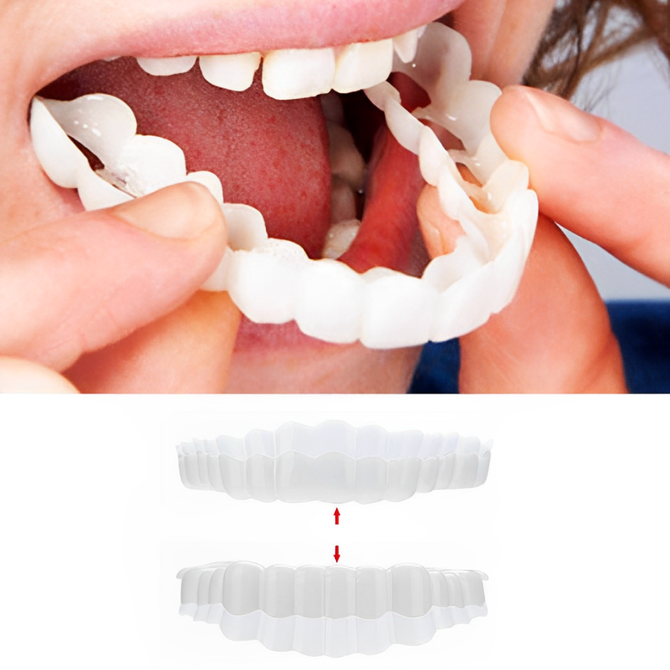 Radiant Smile Veneers – Complete Upper & Lower Set